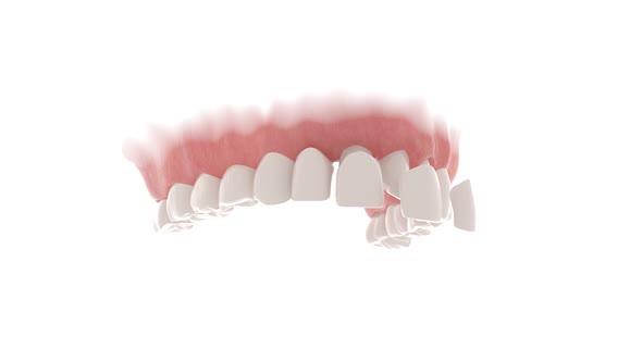 Dental Veneers