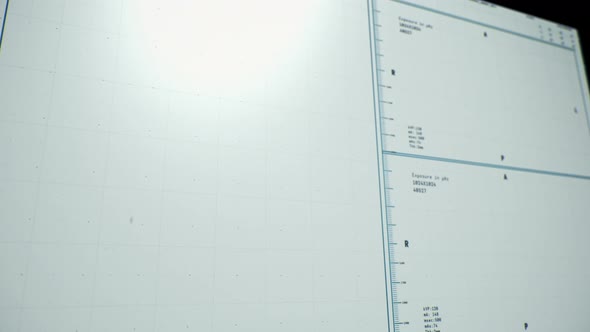 Medical Examination Of Covid Illness Causing Pneumonia In Patients Lungs alt