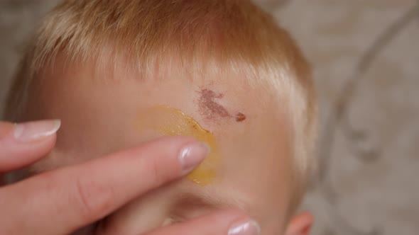 A Caring Mother Applies Ointment to a Scratch and a Bump on Her Son's Forehead