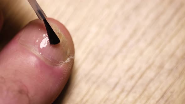 The Man Applies Antifungal Medication to the Infected Big Toe