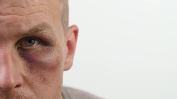 Man with Black Eye Looks at the Camera