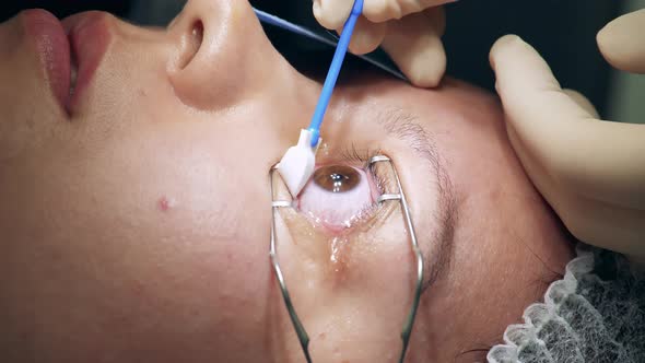 Doctor is Wiping Liquid Off of Patient's Eye During Surgery