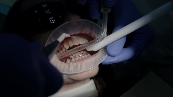 Installing and Cleaning of Dental Braces in Clinic Closeup View of Patient Teeth in Office of