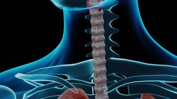 Nodular Goiter in Human Body