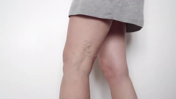 Close Up of Woman Legs with Varicose Veins