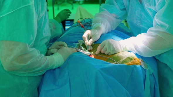 Hands of Doctors in the Operating Room During the Operation