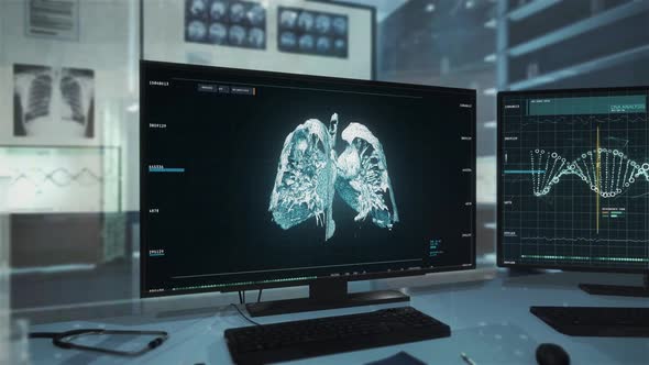 Software has diagnosed lung cancer in a patient after meticulous breast analysis