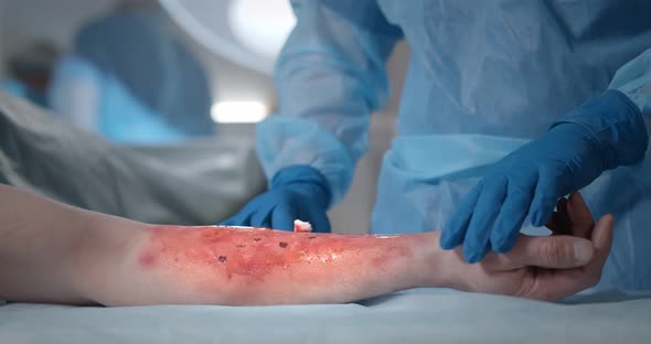 Surgeons Team Working with Burn Wound on Arm of Patient in Operating Room