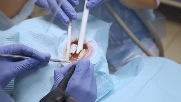 Close-Up Of The Hands Of Two Dentists In Blue Gloves Treating The Teeth Of A Woman