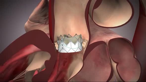 Heart valve side and top view