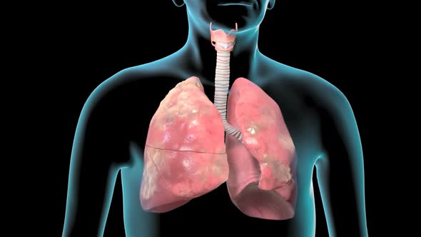 Bronchopulmonary segmental anatomy. Lung cancer