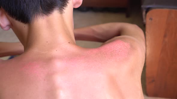 Sunburn signs and symptoms: Pinkness or redness, blisters