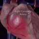 coronary artery 3d emedical anatomy - VideoHive Item for Sale