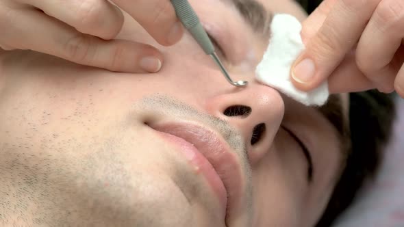 Face Blackheads Removal Close Up