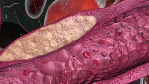 Opening of clotted blood vessels