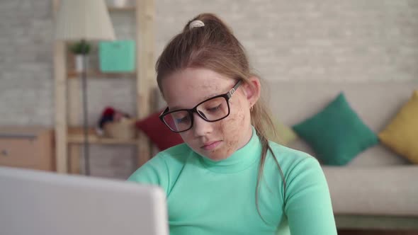 Portrait of a Teenage Girl with a Defect or Face Burn Using a Laptop or Computer