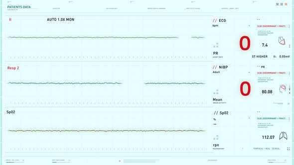 Interface of the monitoring device at the clinic shows the death of the patient alt