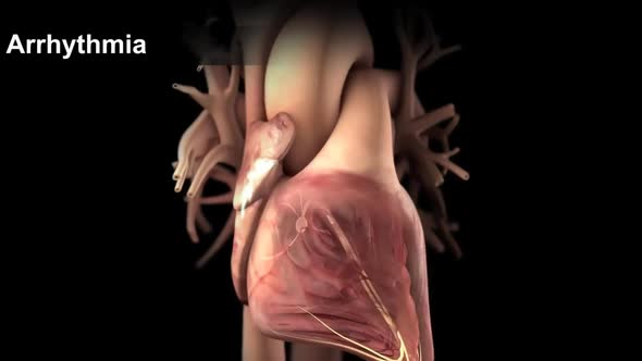 Arrhythmia The normal electrical activity of the heart is the result of the electrical activity