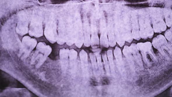 Dental X-Ray of the Jaw with Teeth Against the Light. Sealed Molars. Radiography