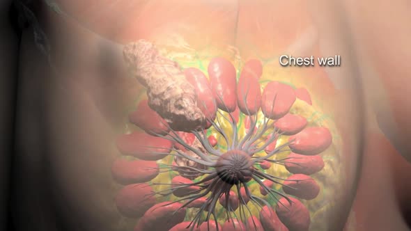 Breast cancer is cancer that forms in the cells of the breasts.