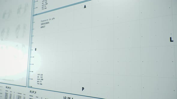 Computer user interface.Modern medical tomography.Pneumonia.Coronavirus.3D lungs alt