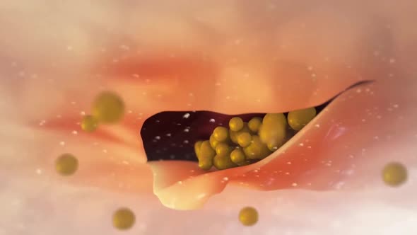 Plaque formation in the cardiovascular tract, cholesterol