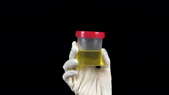 Urine in a Test Jar Close-up. The Doctor Holds a Jar in a Glove on a Black Background.