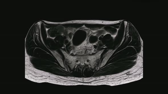 Voluminous MRI of the Female Pelvic Organs, Abdominal Cavity, Gastrointestinal Tract and Bladder