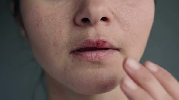 Part of the Face of a Young Woman with Lips Affected By Herpes