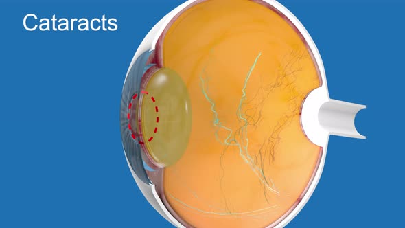3D Medical Animated eye anatomy cataract on blue background