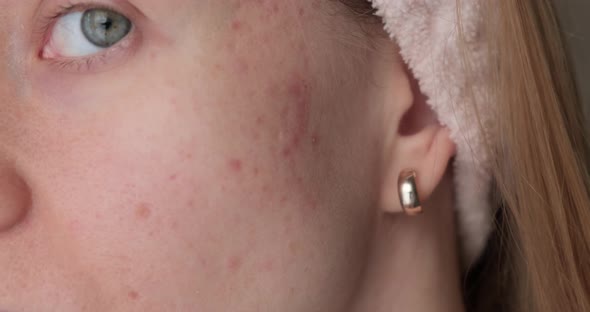 Woman with post acne scars.