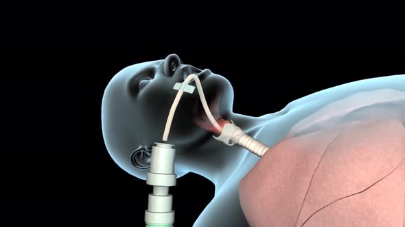 Patient with a endotracheal tube and orogastric Tube