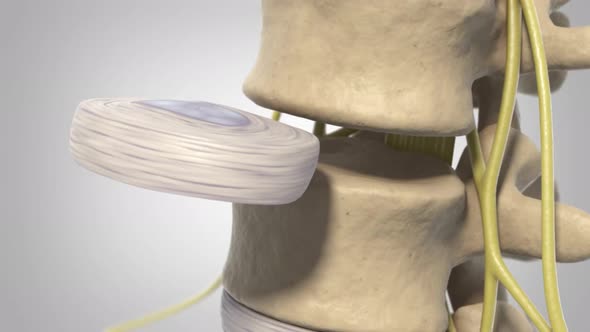 Degenerative dics disease2.mov alt