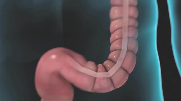 Colonic polyps, extra tissue growing in the colon that can become cancerous.