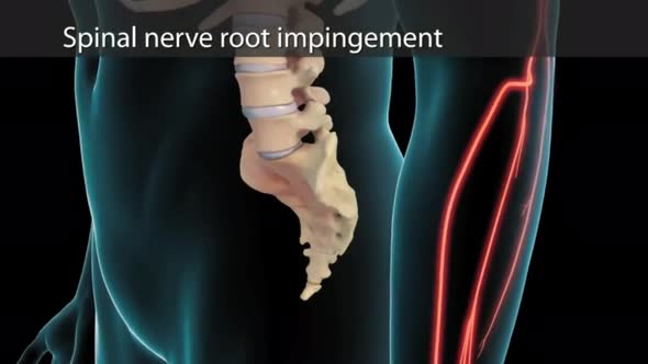 Anatomical view of the cervical spine with intervertebral disc-compressive nerve root prolapse