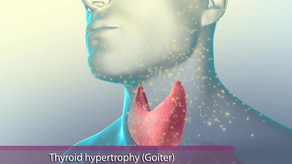 Hyperthyroidism is when the thyroid gland produces more thyroid hormone than your body needs.