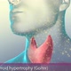 Hyperthyroidism is when the thyroid gland produces more thyroid hormone than your body needs. - VideoHive Item for Sale