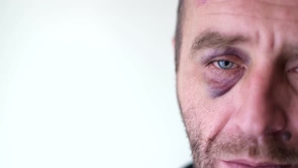 A Man with Alcohol Dependence He Has a Hematoma on His Face