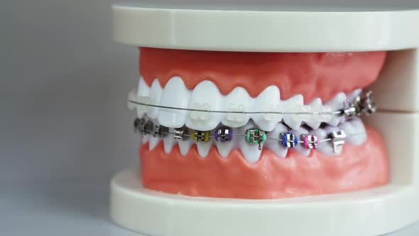 Human Jaw Model with Different Types of Braces