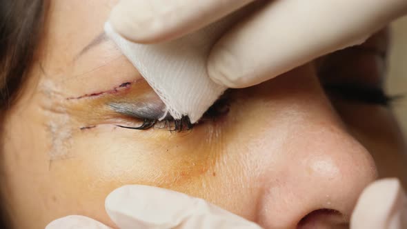 Lubrication Wounds After Blepharoplasty Eyelids