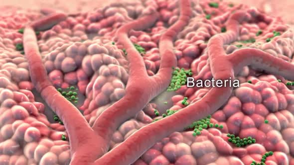 Animatied of infected wound ,bacteria , pus, abscess