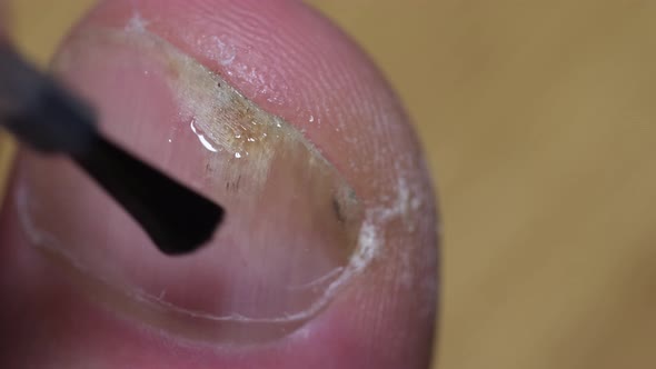 A Man Applies Medicine for Nail Fungus on His Toes