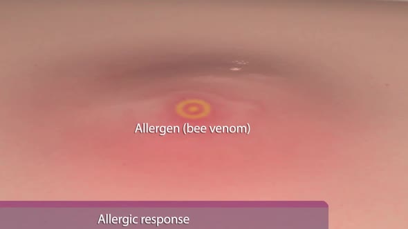 Allergic reaction on human skin