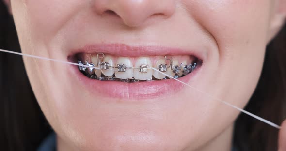 Closeup Female Brushing Teeth in Metal Braces By Dental Floss