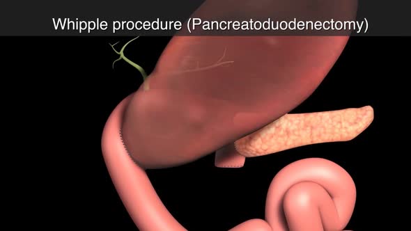 Animatied Human Digestive System.whipple Procedure (Pancreatoduodenectomy)