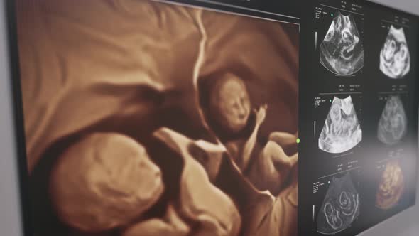 Diagnostic check found identical twins inside of the pregnant female belly