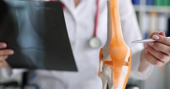 Therapist Examines Xray of the Model of Knee Joint and Tendons