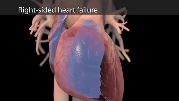 Right sided heart failure