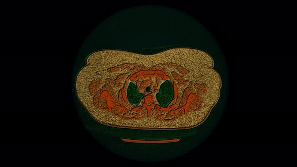 Color MRI Scan of the Lungs and Bronchi, Diagnosis of Respiratory Diseases