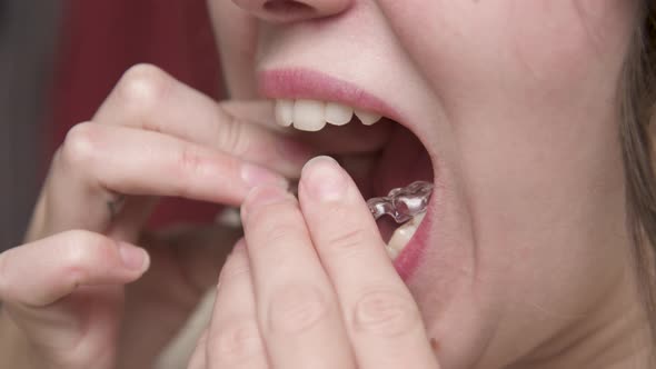 Mouth Closeup A Young Woman Puts a Corrective Aligner Splint on Her Lower Teeth to Correct an